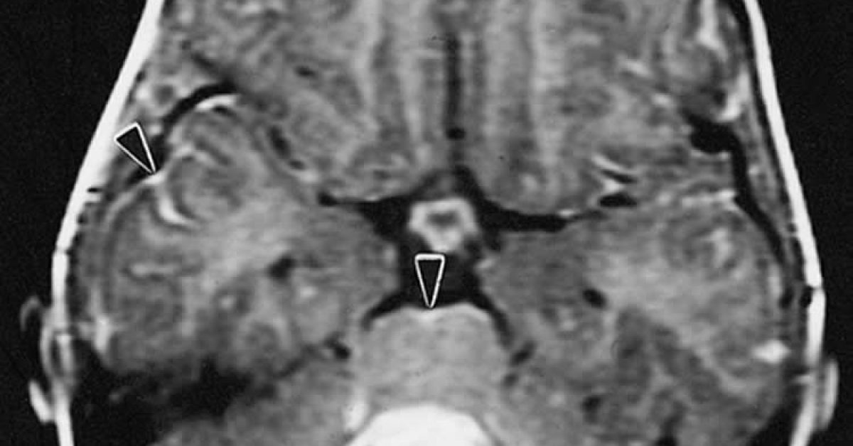 medullablastoma-antidepressant-treatment.jpg