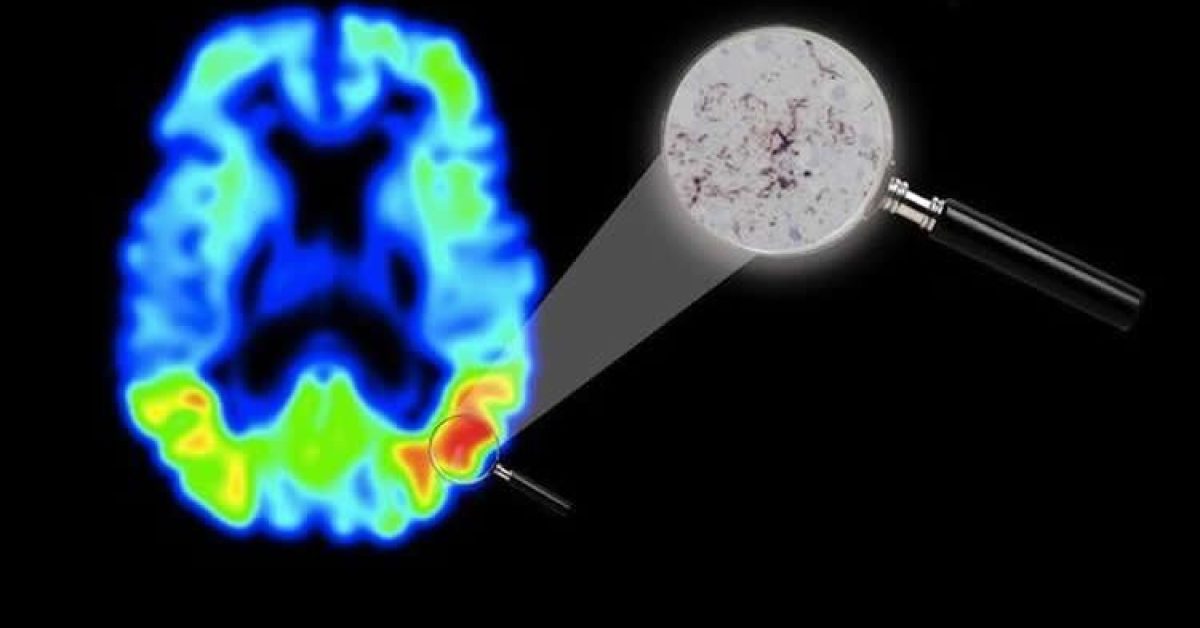 pet-alzheimers-pharmacology-neurosciencneews.jpg