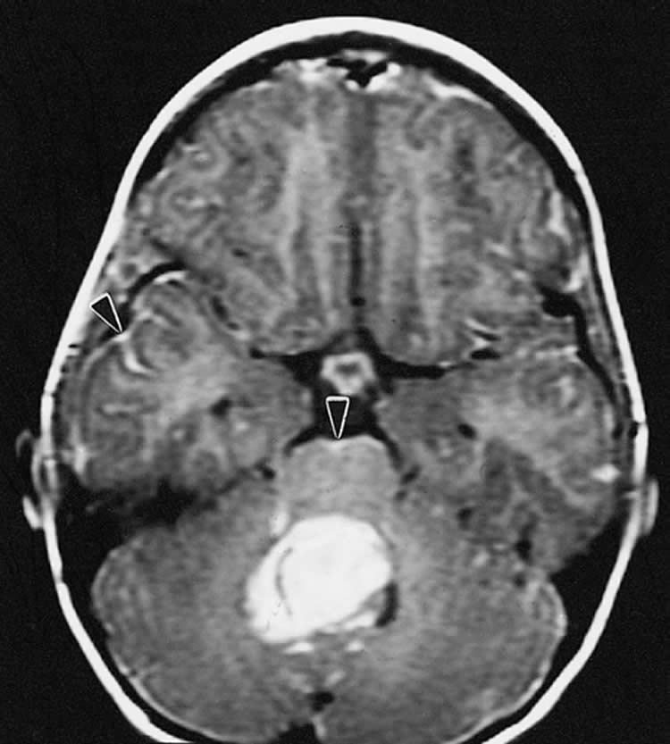 Study Suggests Repurposing Antidepressant Medication to Target Medulloblastoma