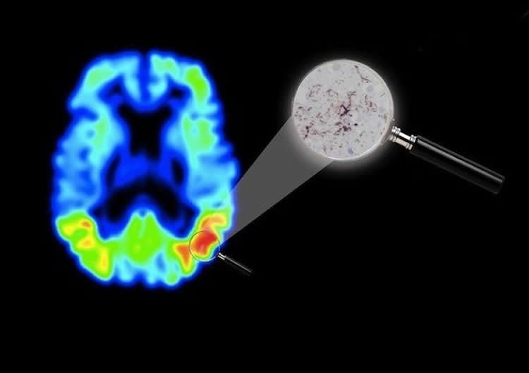 New Imaging Technique Opens Possibility for Alzheimer’s Drug Development